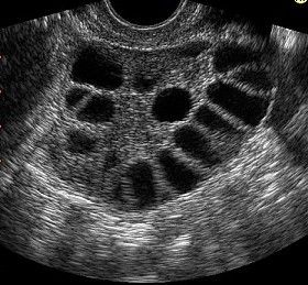 polycystic ovarian syndrome polycystic ovary syndrome